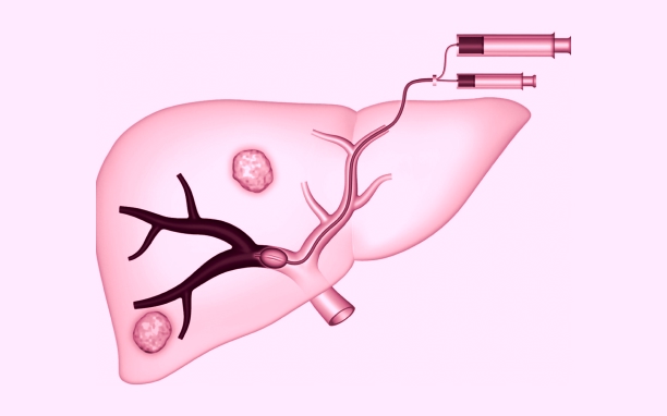 Portal Vein Embolization